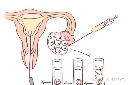 体外受精 IVF-ET